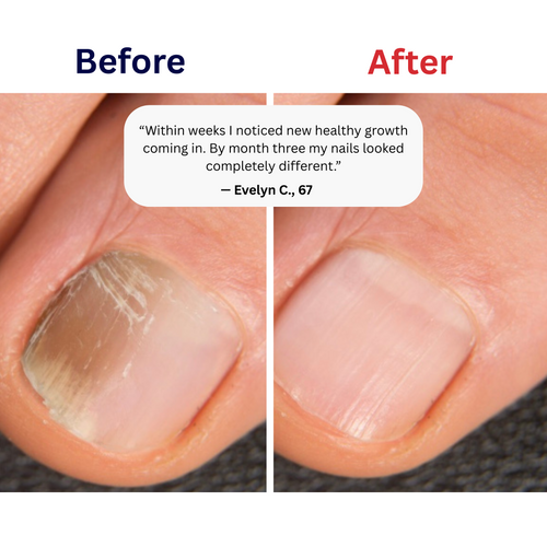 Fungal Nail Patches